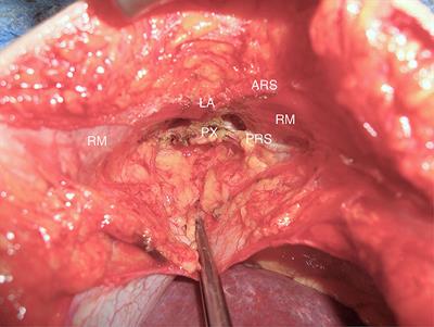 Laparoscopic vs. Open Surgical Repair of Subxiphoidal Hernia Following Median Sternotomy for Coronary Bypass - Analysis of the Herniamed Registry